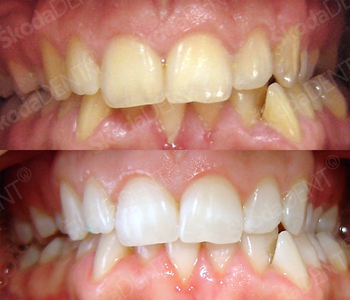 Teeth Whitening ( Bleaching)