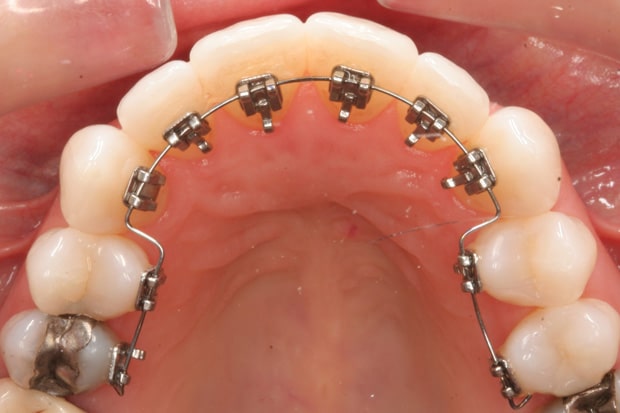 lingual-orthodontics