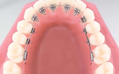 Lingvalna ortodoncija