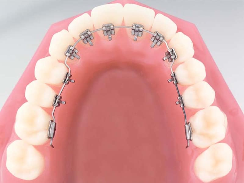 Lingvalna ortodoncija