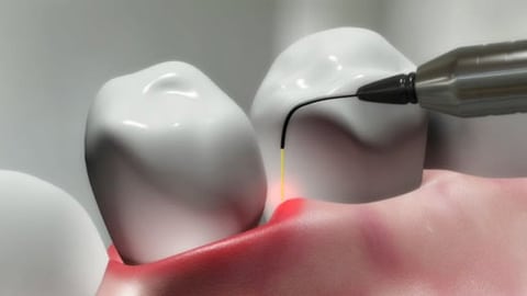 laser-za-zube