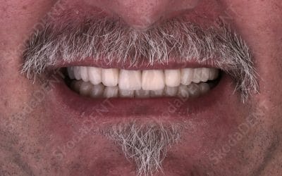 Zobne luske in krone brez brušenja zob “Non-prep” – rešitev za izrabljene zobe